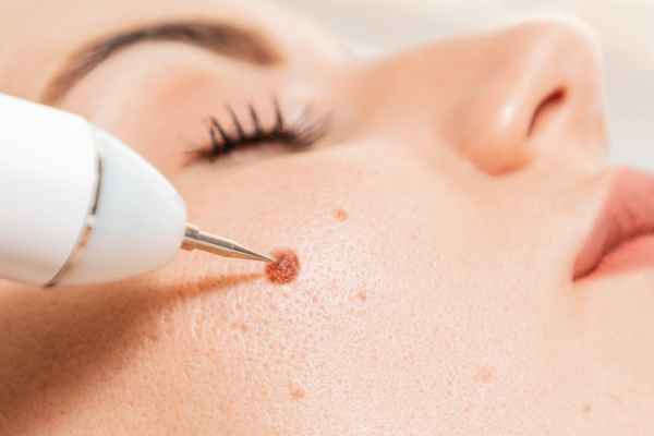 CryoPen: 5 Skin Concerns It May Be Used to Treat 3 What actually happens during a CryoPen treatment Sudbury?