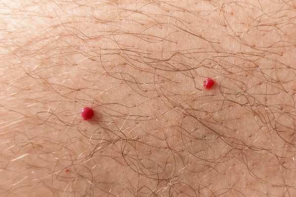 CryoPen: 5 Skin Concerns It May Be Used to Treat 2 cherry angioma removal Sudbury