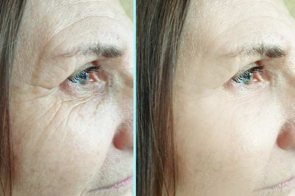 Why Do People Choose HIFU for a Non-Surgical Facelift? 4 How long can HIFU results last Sudbury?