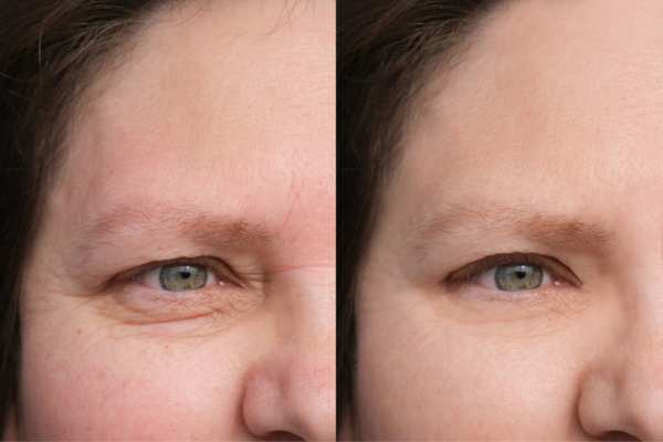 HIFU vs Botulinum Toxin: Understanding the Differences 4 How long do HIFU results last Sudbury?