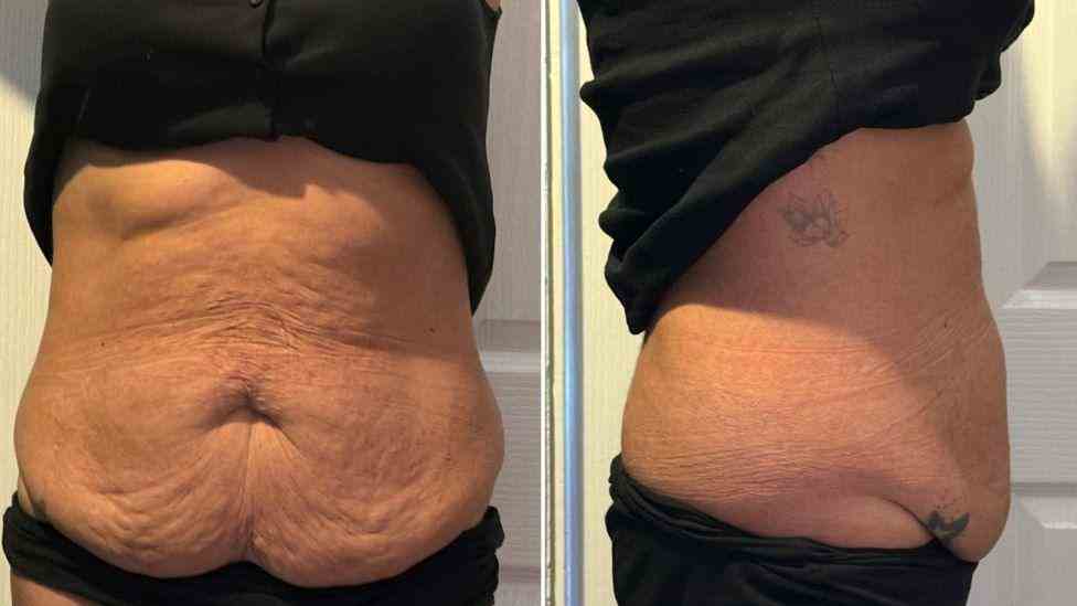 Lost the Weight but Not the Loose Skin? What You Should Know 1 Is It Definitely Loose Skin Sudbury?